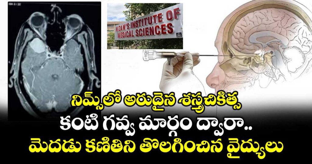 a-rare-surgery-in-nims-doctors-removed-a-brain-tumor-through-the-eyeball-route_iEpq4KhX23