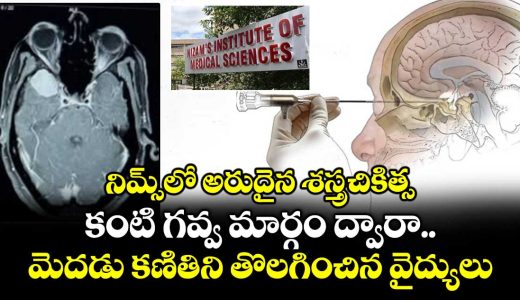 a-rare-surgery-in-nims-doctors-removed-a-brain-tumor-through-the-eyeball-route_iEpq4KhX23