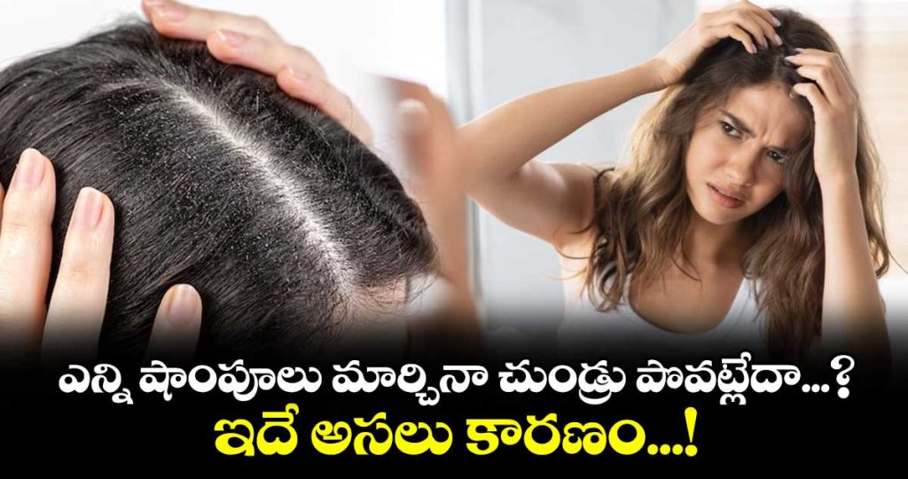 why-your-dandruff-keeps-coming-back-and-what-your-scalp-may-be-trying-to-tell-you_wGS5d9rtKv